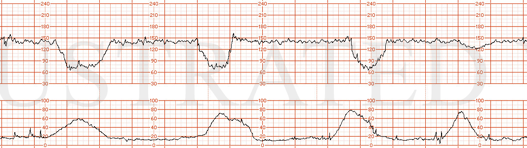 STRIP 185 1. 15-20 min tracing with baseline rate in 140s and moderate variability. Recurrent significant variable decelerations which nadir at 70bpm lasting 1-2 minutes. , along with a single late deceleration towards the end of the strip