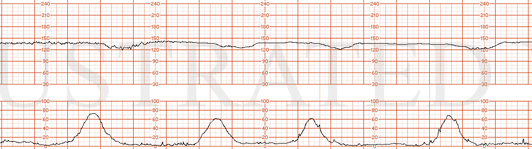 STRIP 186 1. Baseline initially for 4 minutes is 140 bpm, with minimal variability and then late decelerations (nadir around 110) become recurrent with each contraction starting at minute 5 through 15. Contractions occur every 2-3 minutes and variab…