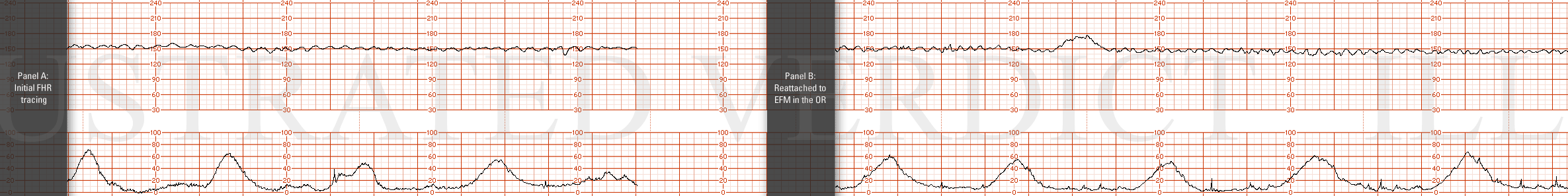STRIP 187 1. Panel A: show 7-8 minutes of a pseudo-sinusoidal pattern with no decelerations and no accelerations; range of baseline between 120-160 bpm. Show about 2-3 minutes no FHRT indicating off the monitor. Contractions are every 3 minutes Pane…