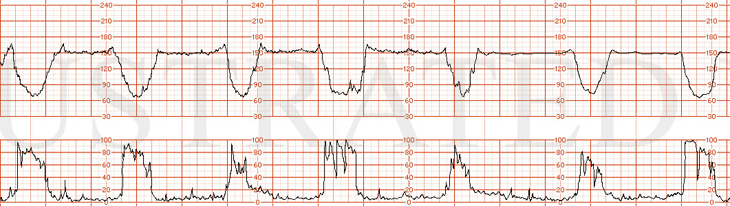 STRIP 188 1. 15 minutes of strip; first few minutes is Category II with minimal variability and recurrent significant variable decelerations; the last several minutes- becomes Cat III (near absent variability and recurrent variables). Normal baselin…