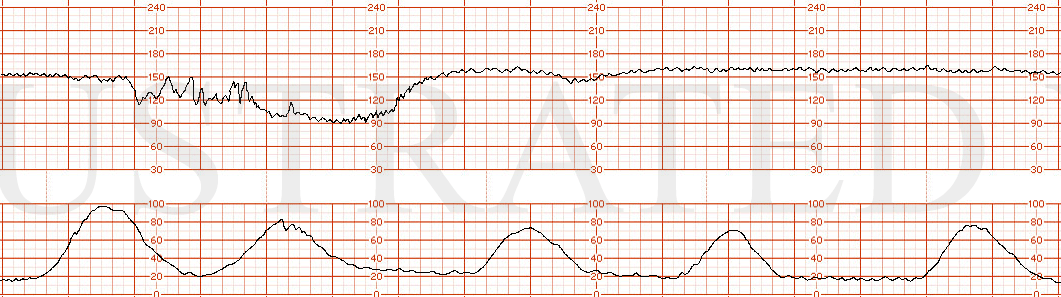 STRIP 189 1. 150s baseline with prolonged deceleration with a nadir in 80s but with gradual decline and variability present in deceleration. Recovery to baseline but with single late deceleration with first contraction post prolonged decel and then …