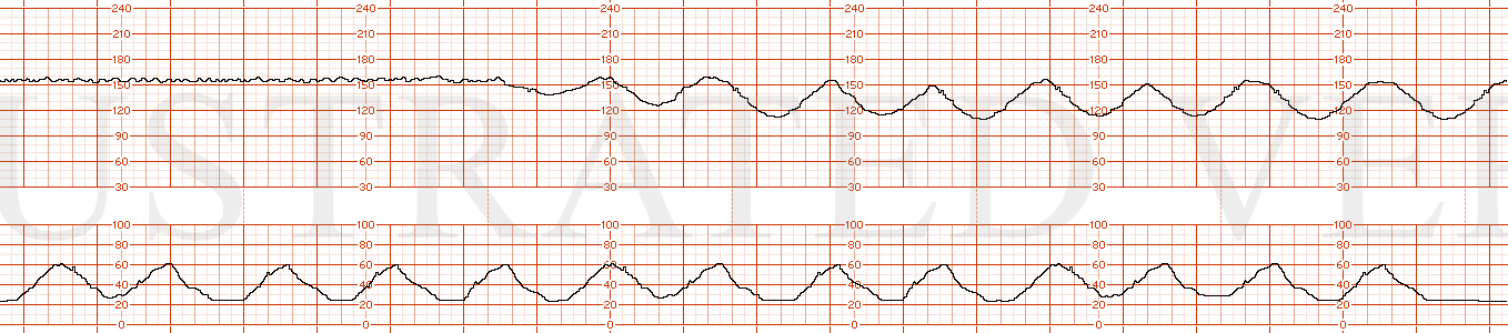 STRIP 191 1. Sinusoidal heart rate pattern