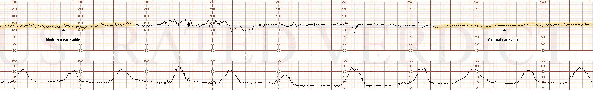 STRIP 195 1. MOderate variability to minimal variability