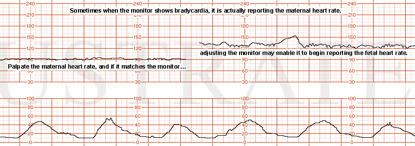 STRIP 201 1. Bradycardia might be maternal heart rate
