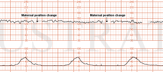 STRIP 203 1. Spaces in fetal heart rate can be from maternal movement