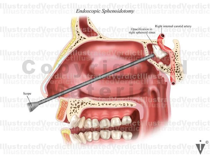 Stock Nose / Sinus Anomalies / Surgery — Illustrated Verdict