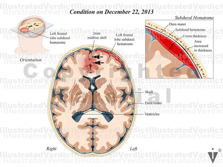 Stock Brain: Hemorrhages — Illustrated Verdict