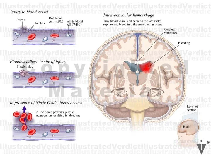 Stock Brain Hemorrhages Illustrated Verdict Stock Brain Hemorrhages Illustrated Verdict