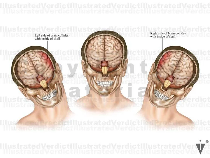 Stock Brain: Injuries — Illustrated Verdict
