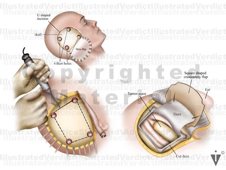 Stock Brain: Surgical Approaches — Illustrated Verdict
