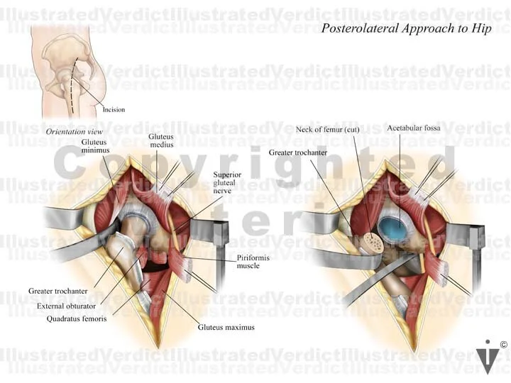 CASE AT A GLANCE: Sciatic Nerve Injury w/ Hip Replacement ...