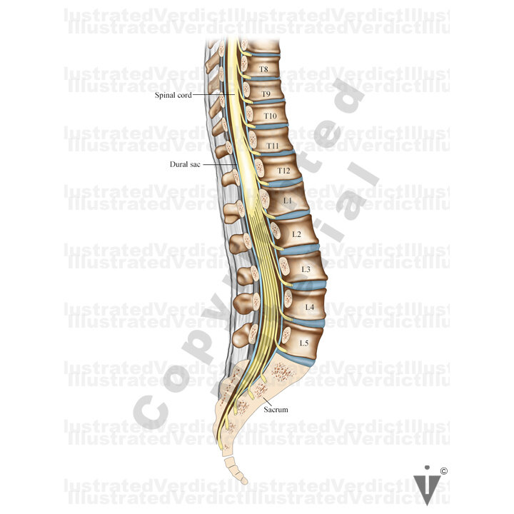 Image 09384: Spinal Cord Stimulator Illustration