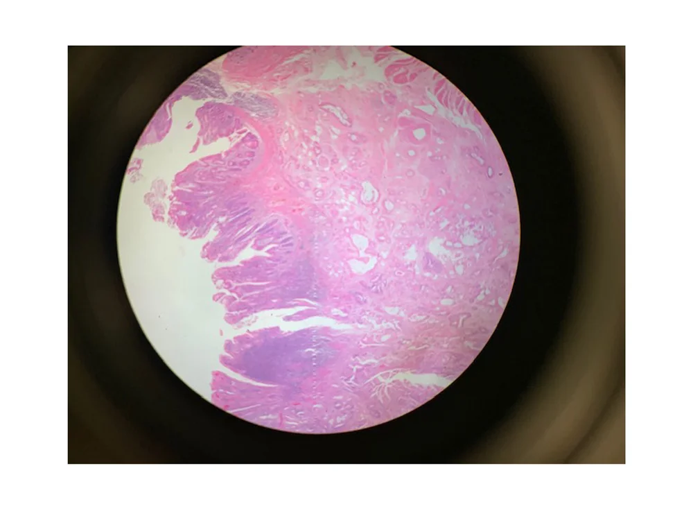 CASE AT A GLANCE: Colon Cancer of the Appendix — Illustrated Verdict
