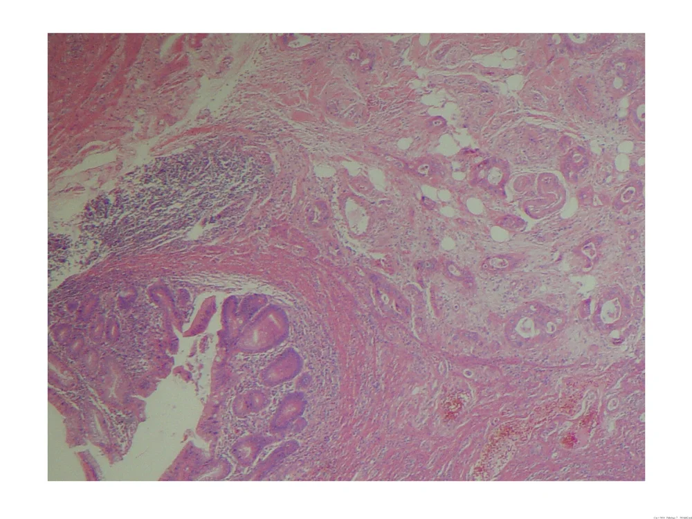 CASE AT A GLANCE: Colon Cancer of the Appendix — Illustrated Verdict