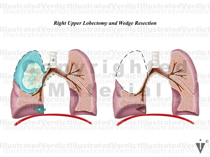 CASE AT A GLANCE: Lung Cancer / Right Upper Lobectomy — Illustrated Verdict