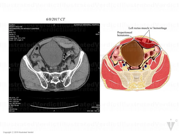 CASE AT A GLANCE: Complications after Robotic Inguinal Hernia Repair — Illustrated Verdict