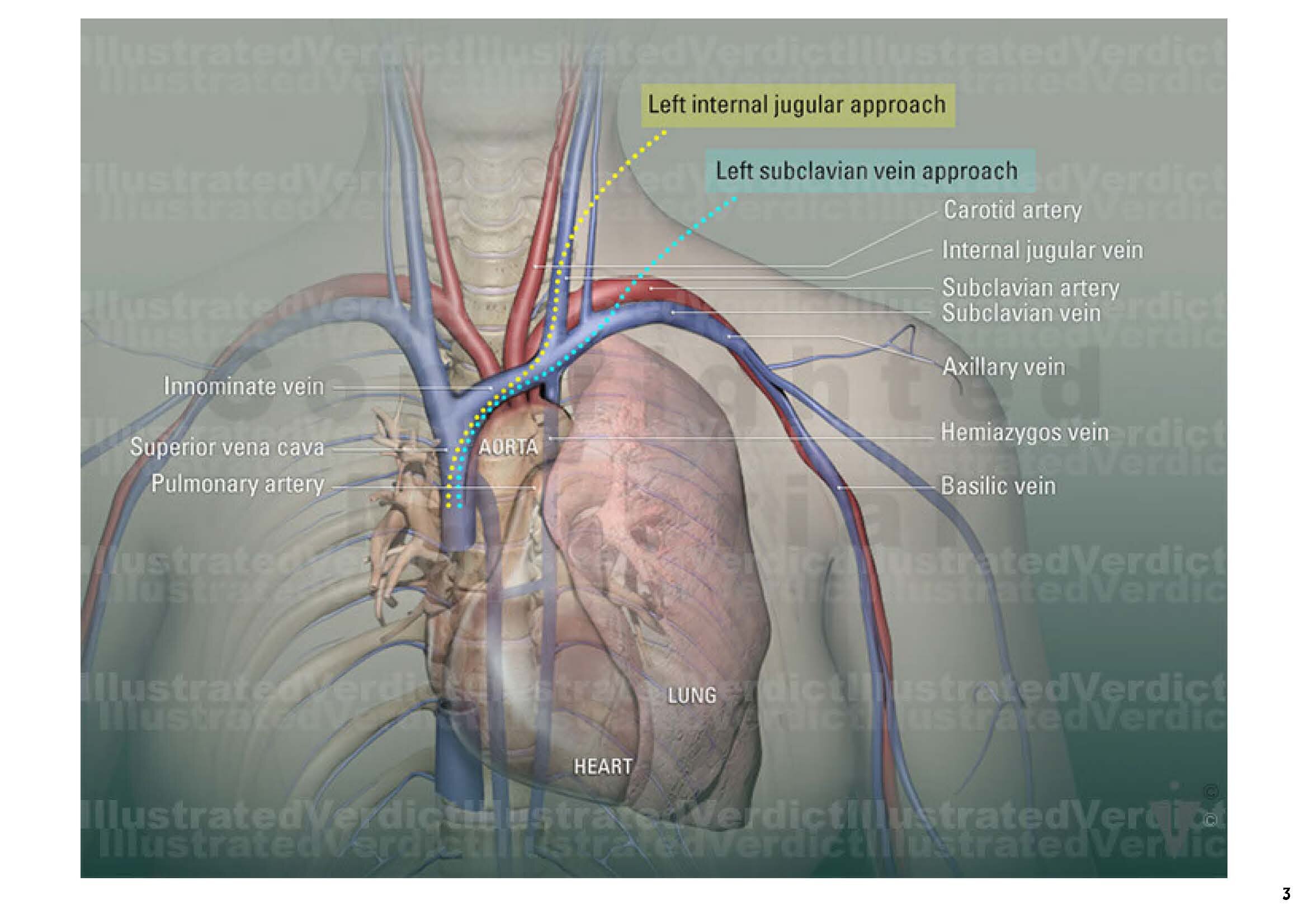 CASE AT A GLANCE: Chemo Port Placement Venous Access — Illustrated Verdict