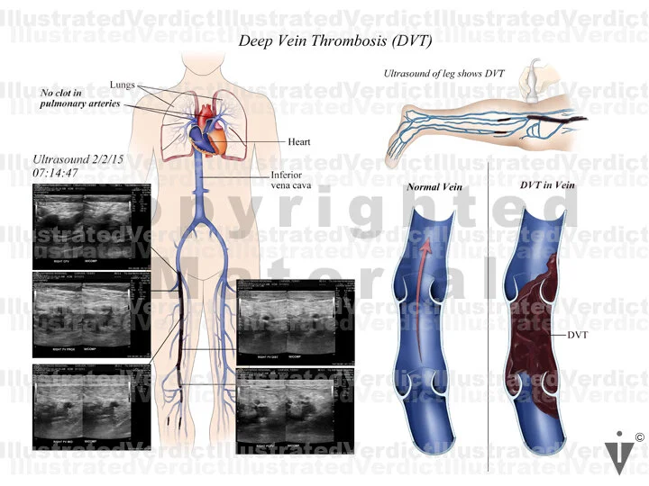 CASE AT A GLANCE: Extensive DVT and Anticoagulants — Illustrated Verdict