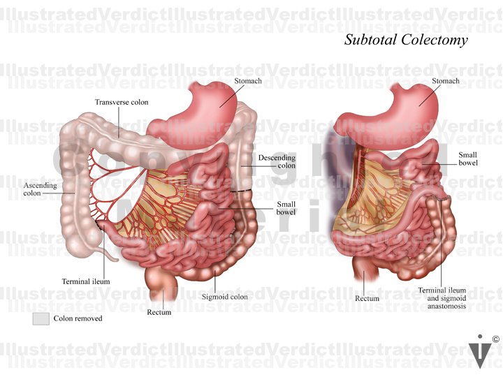 CASE AT A GLANCE: Subtotal Colectomy / Aortic Atherosclerosis ...