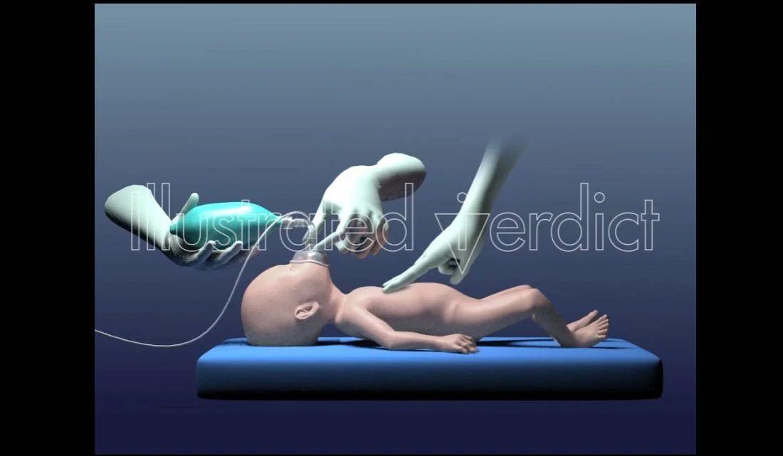 Infant Resuscitation w/ Chest Compressions