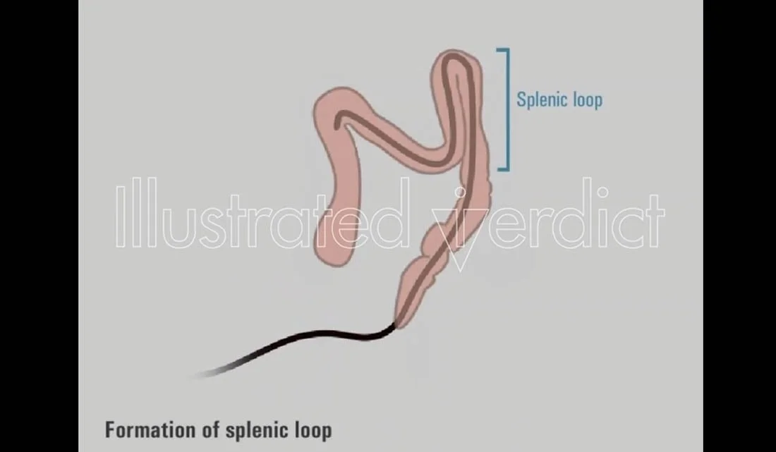 Colonoscopy