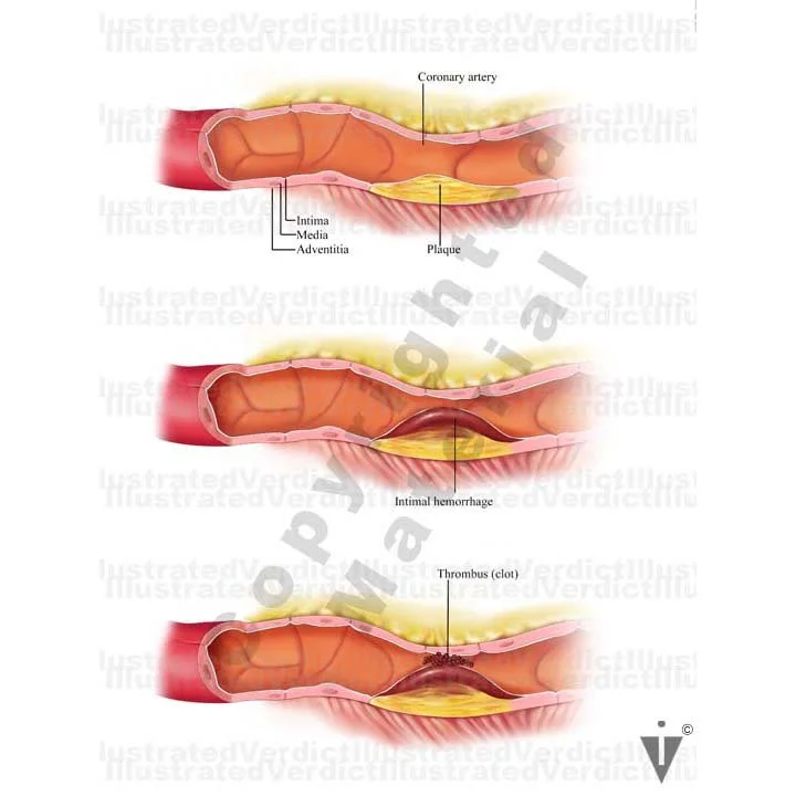 CASE AT A GLANCE: Cardiac Rupture Following Heart Attack — Illustrated ...