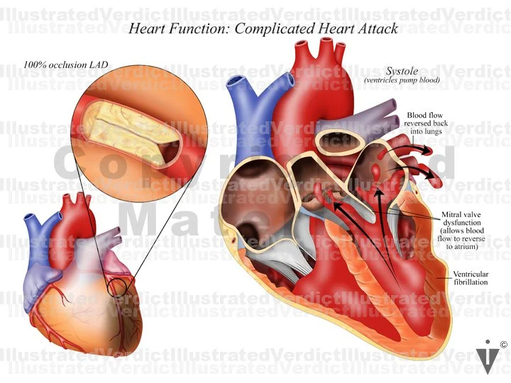 Right Atrial Rupture CASE AT A GLANCE: Cardiac Rupture Following Heart Attack — Illustrated ...