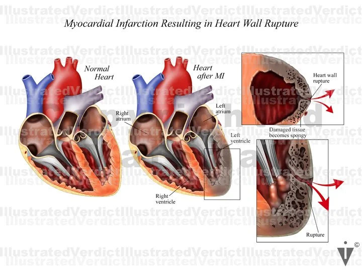 CASE AT A GLANCE: Cardiac Rupture Following Heart Attack — Illustrated ...