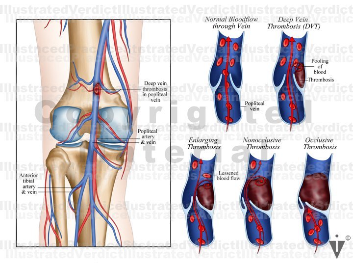 Dvt Examples Stock Lungs: Pulmonary Embolism — Illustrated Verdict