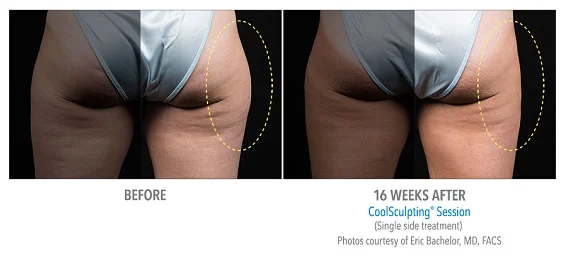 coolsculpting-treatment1.jpg