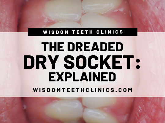 Dreaded Dry Socket: Explained — Wisdom Teeth Clinics