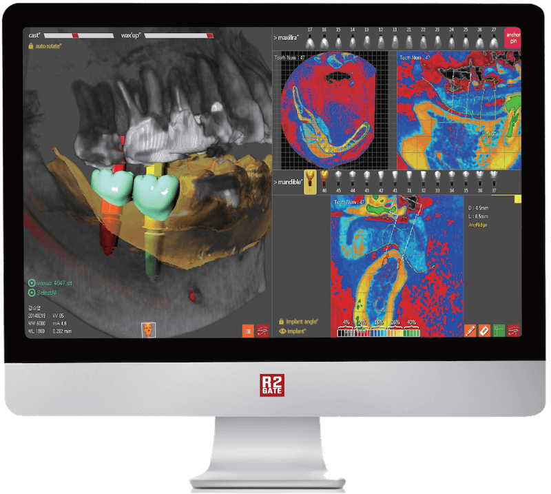 R2Gate Implantatsiooni simulatsioon