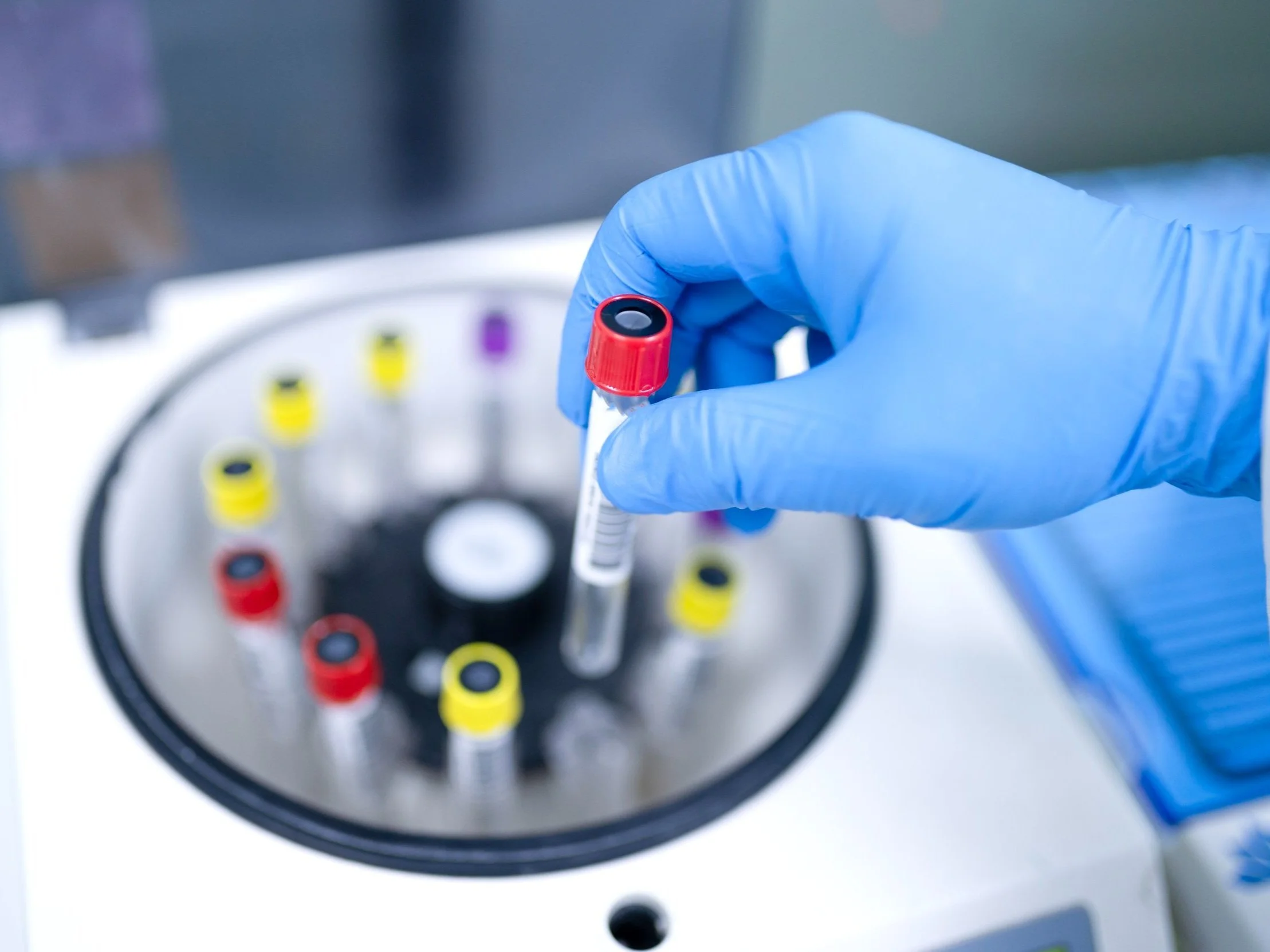 iPSCs in Development for Myhre Syndrome