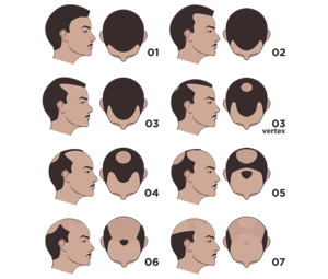 The Norwood Scale of Balding