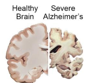 Image source: https://www.nia.nih.gov/health/alzheimers-disease-fact-sheet