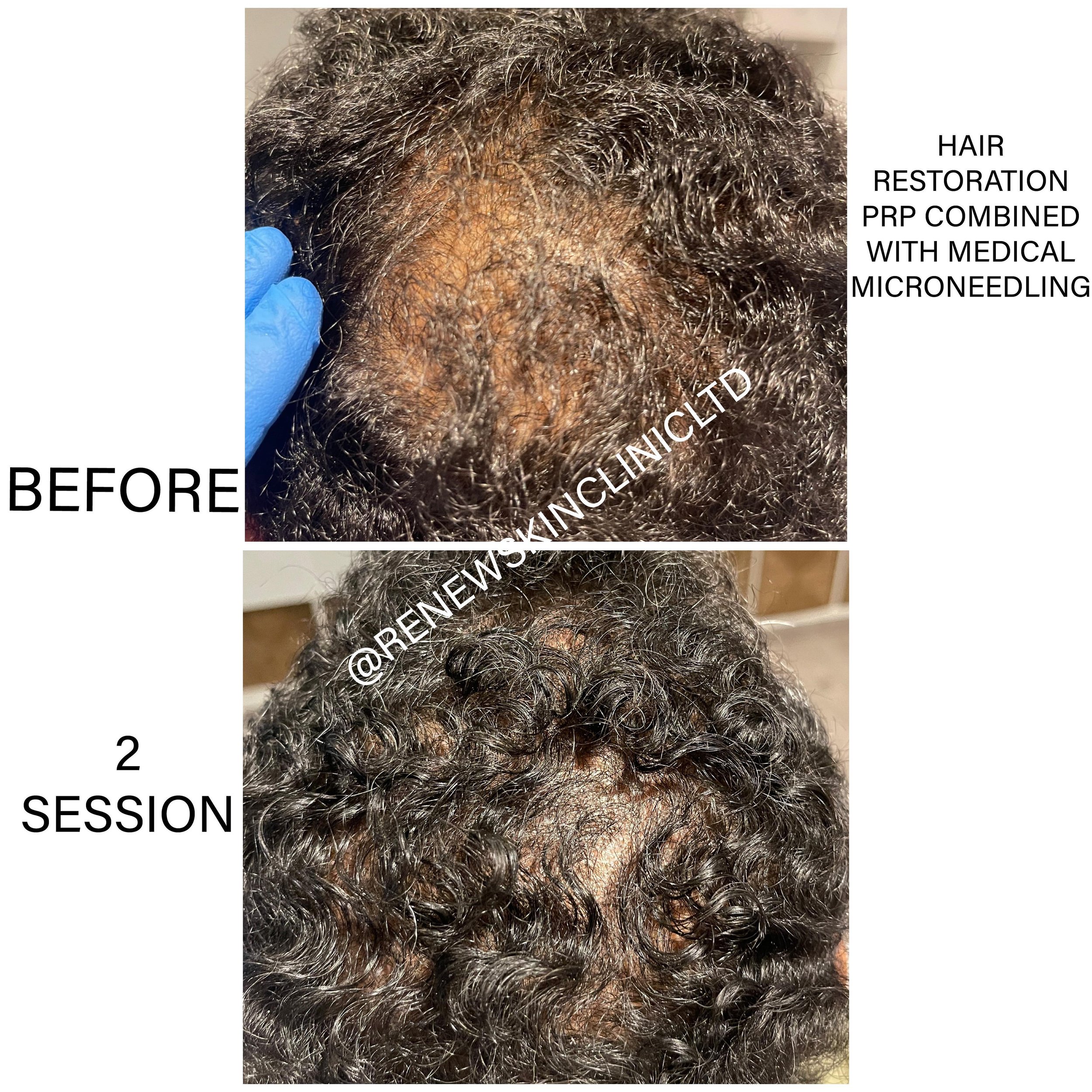 HAIR RESTORATION WITH PRP COMBINED WITH MEDICAL MICRO NEEDING!🩸
.
. 
⭐️⭐️ONLY 2 SESSION SO FAR! LOOK AT THAT GROWTH!  HAD THE THIRD ONE TODAY ❤️
.
.
👉PLEASE NOTE - results varies between clients and how much sessions is needed to see desire results