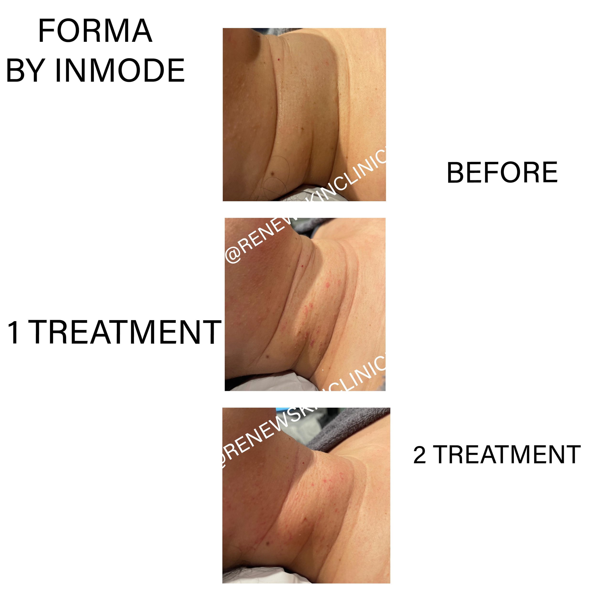 FORMA HERE WE COME!!🙌
.
.
👉👉LOOOK AT HER AMAZING RESULTS!! .
.
☑️tightening  of the Neck 
☑️decrease appearances loose skin 
☑️stimulation of collagen production + elastin.
☑️skin feels firmer + smoother to touch as per the client .
☑️some of the 