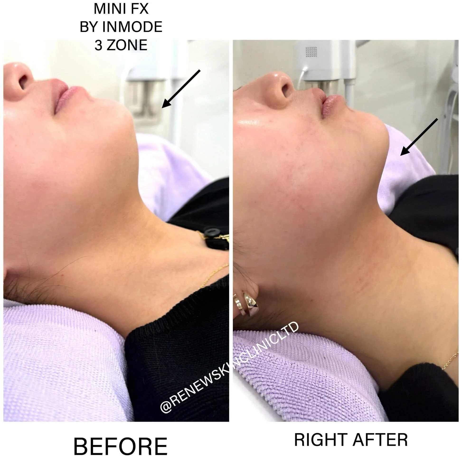 ⭐️WHAT IS MINIFX ⭐️ 

▪️IS A NON-INVASIVE TECHNOLOGY WITH RADIO-FREQUENCY (RF)  ENERGY AND NEGATIVE PRESSURE ( A HEATED MASSAGE SUCTION ) TO  DESTROY FAT CELLS, IMPROVES CONTOURS, AND REDUCE CELLULITE WHILE BOOSTING COLLAGEN AND ELASTIN TO HELP TIGHT