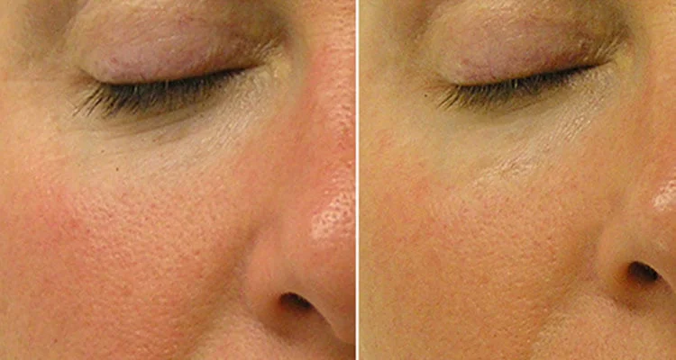 Hydrafacial1.jpg