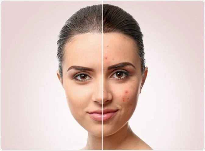 acne.jpg