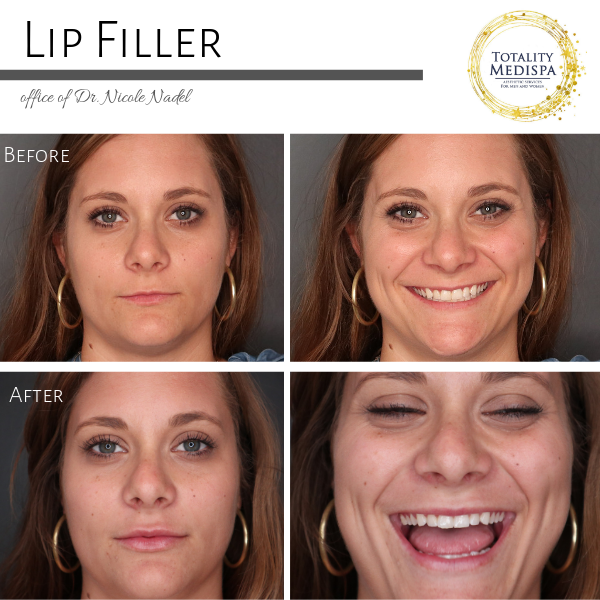 Gallery of Before and After Pictures — Totality Medispa