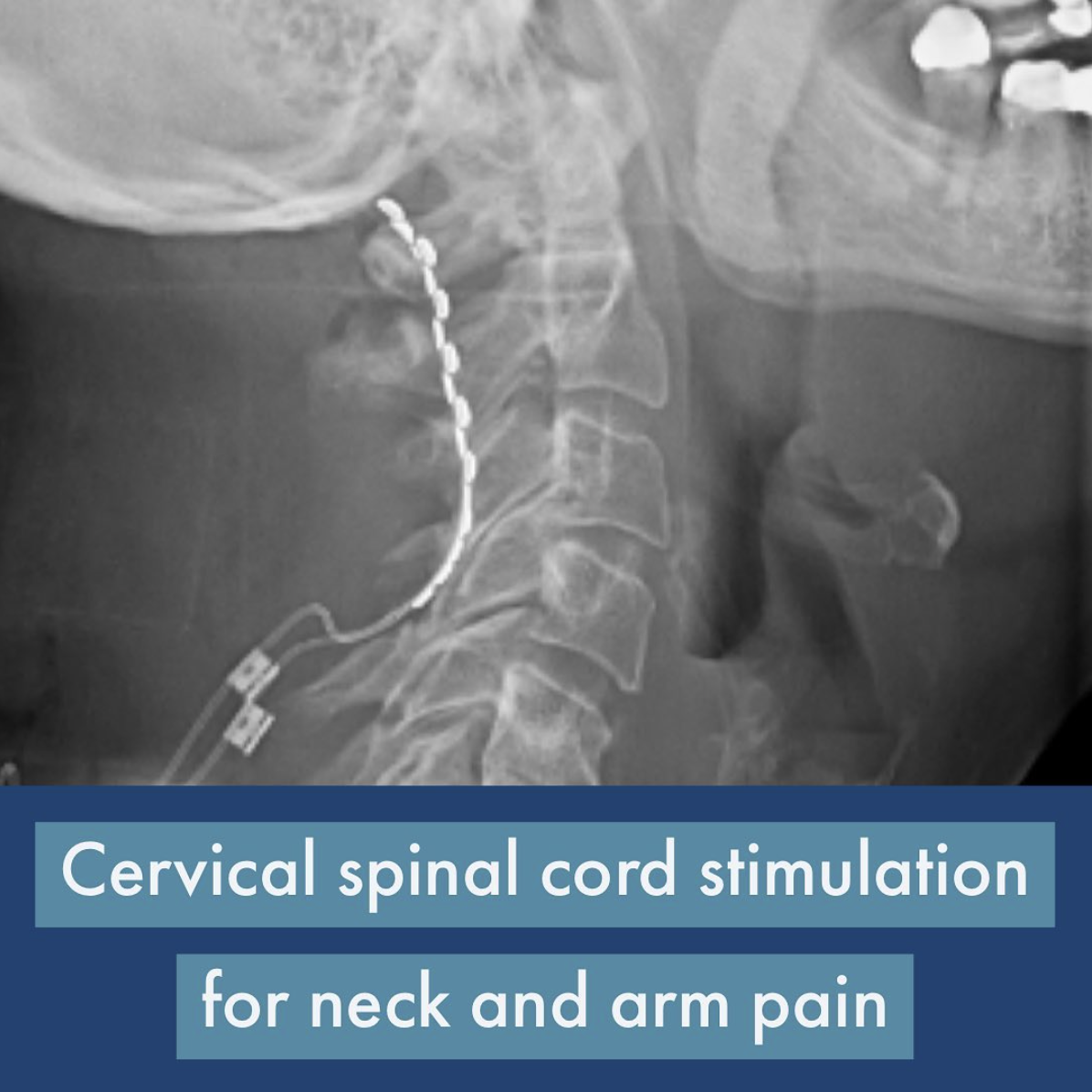 Pain Management Center: Spinal Cord Stimulators and Cervical Radio