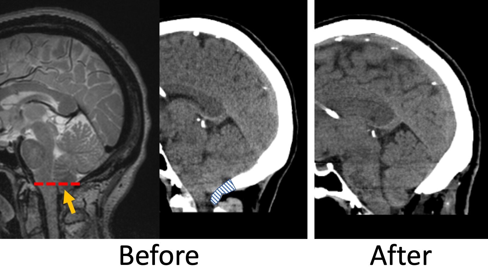 Chiari Malformation — Matthew Mian, MD