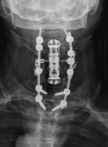 Cummings Post AP.jpg