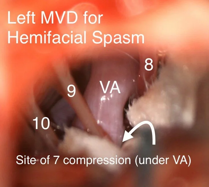 Hemifacial spasm is an uncommon neurologic disorder in which there is chronic, uncontrolled twitching of one side of the face. The usual cause is irritation of the facial nerve by an otherwise normal artery in the brain. 

Although not dangerous, hem