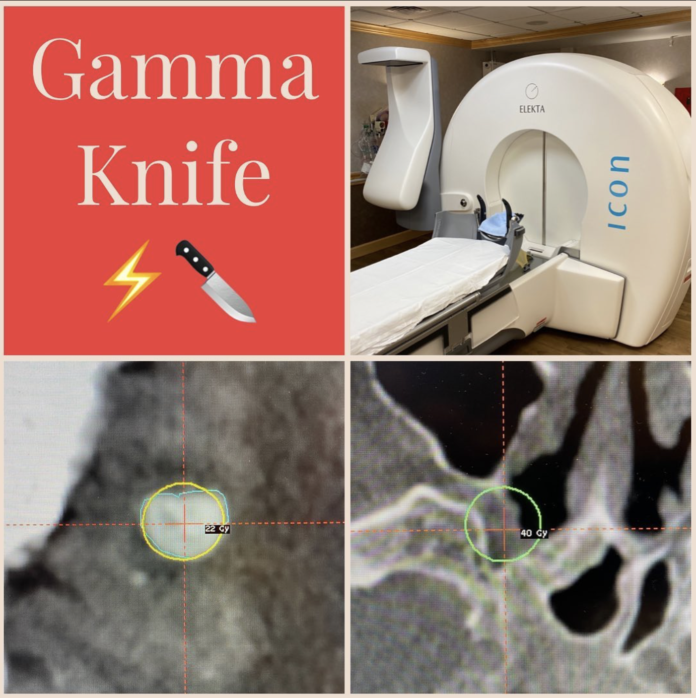 Gamma Knife — Matthew Mian, MD