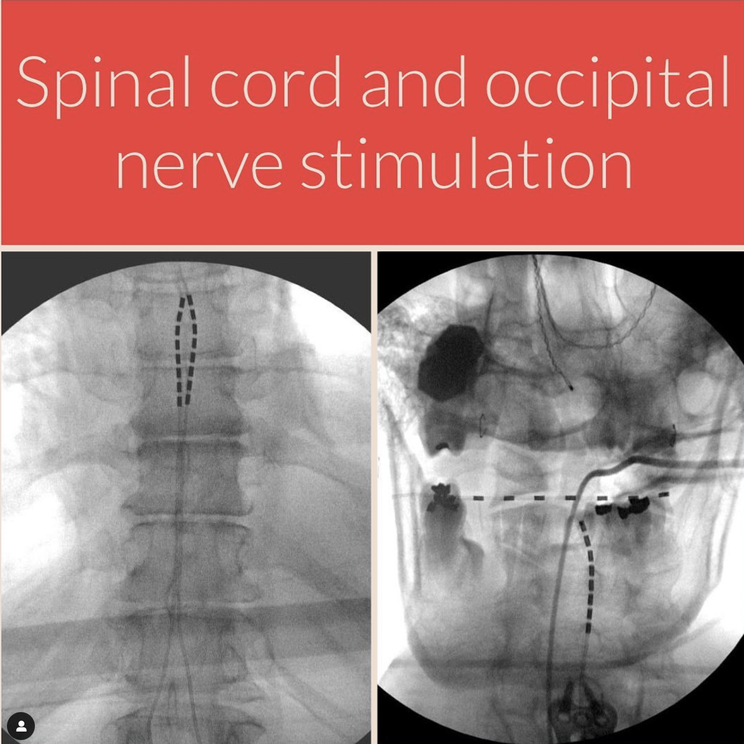 Spinal Cord Stimulation, CorTec