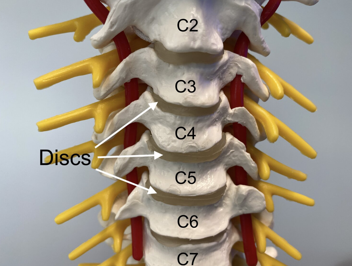 Two Level Disc Replacement ACDR Patient Guide — Matthew Mian, MD