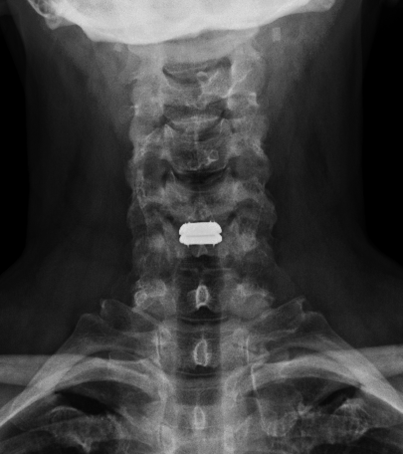 Cervical Disc Replacement — Matthew Mian, MD