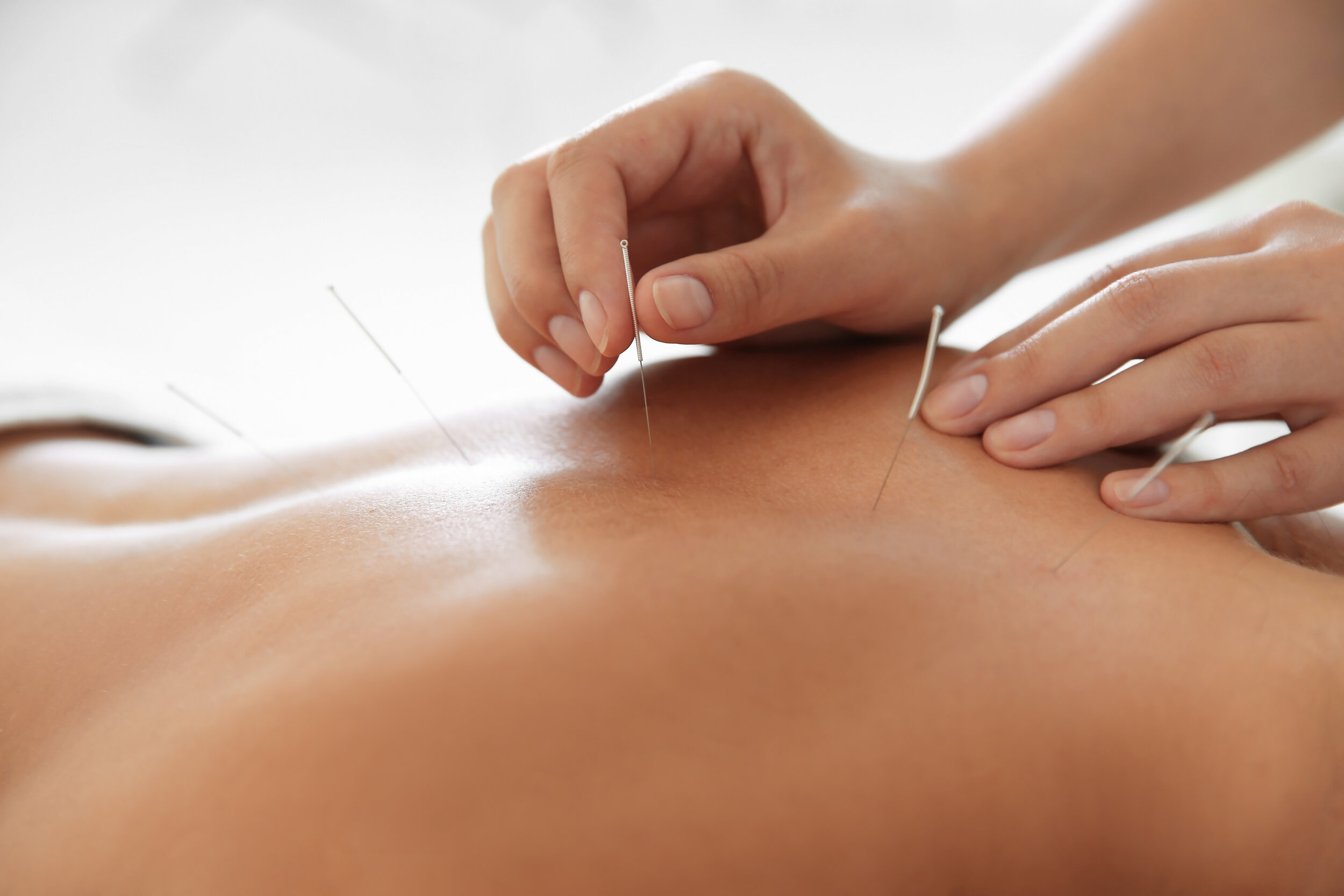 Medical Acupuncture — Lincoln Family Medicine Center